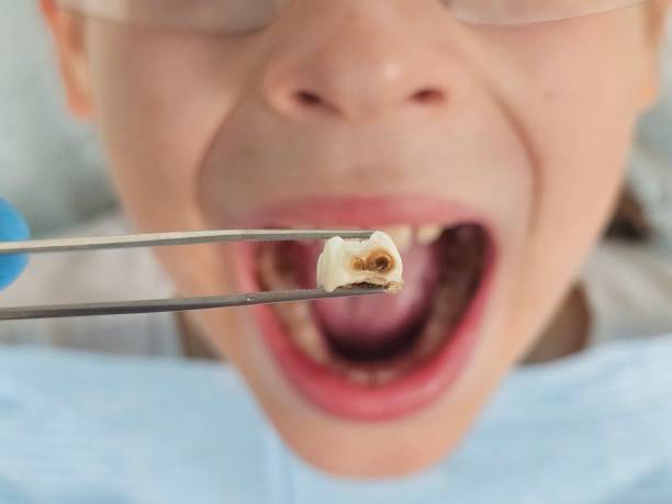 Best Emergency Dental Care for Broken or Chipped Teeth in American Fork, UT